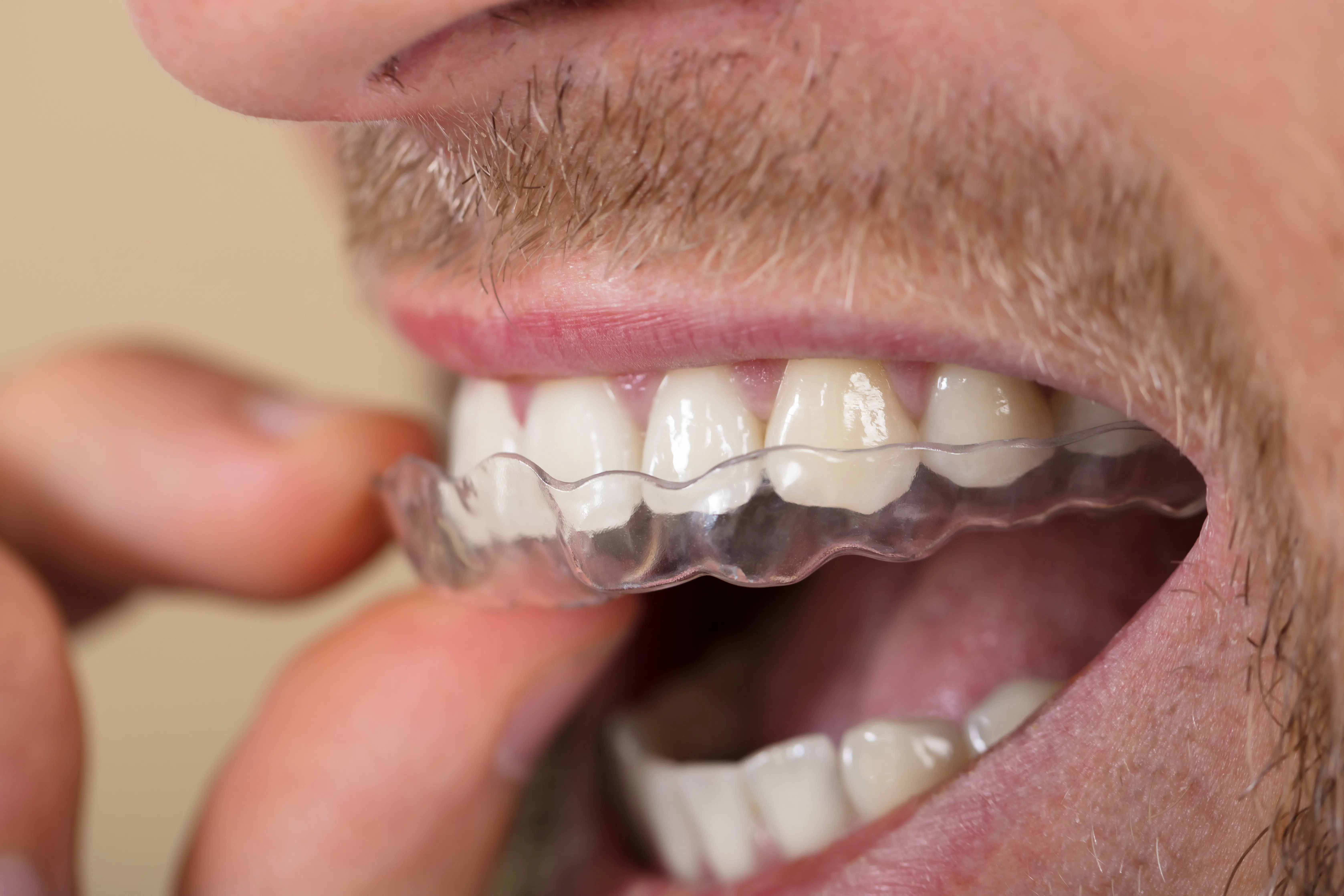 Occlusal Guard in Greenville, SC