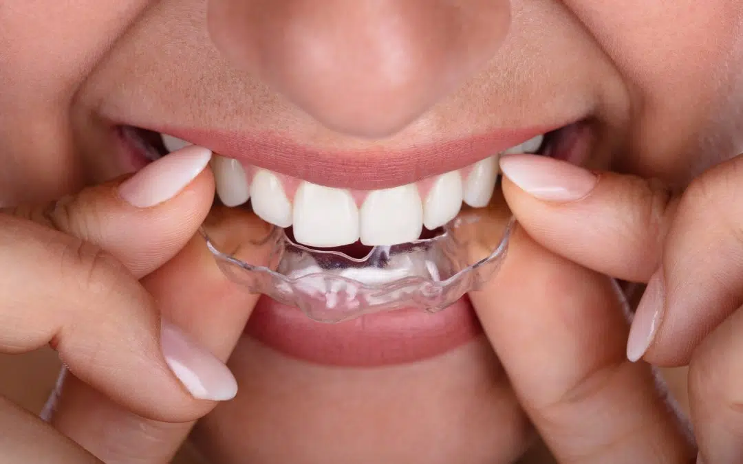 Clear Aligner Treatment in Greenville, SC