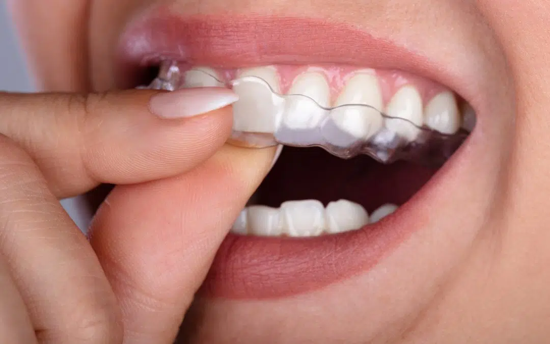 Clear Aligners in Greenville, SC